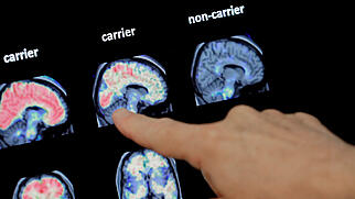 Ein Forschungsdurchbruch macht Hoffnung für die Behandlung von Alzheimer-Patienten. (Symbolbild)